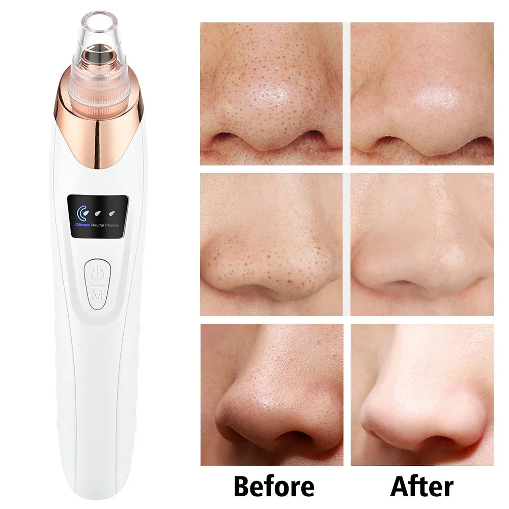Blackhead Pore Cleaner - Men and Women